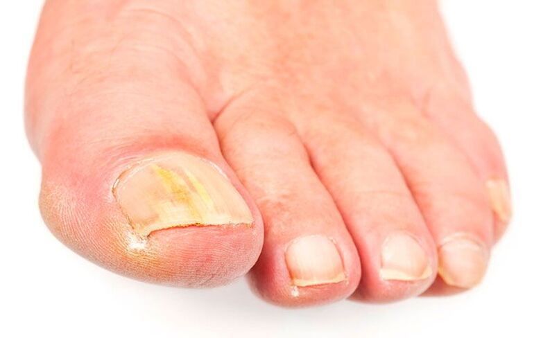 Τις αιτίες του μύκητα