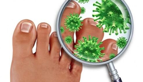 Μύκητας νυχιών