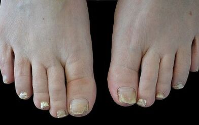 Πώς να απαλλαγείτε από τον μύκητα στα δάχτυλά σας