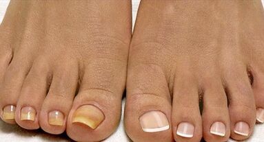 Μέθοδοι θεραπείας μύκητας στόλου