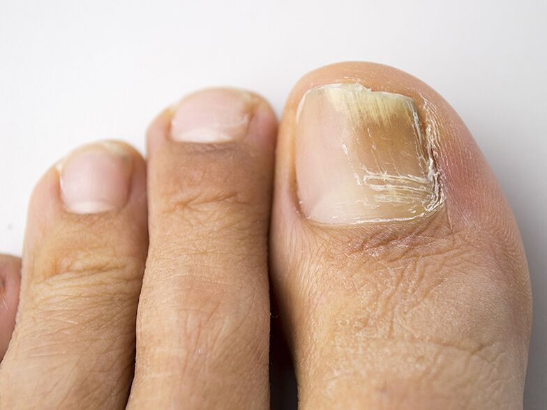 Το αρχικό στάδιο του μύκητα