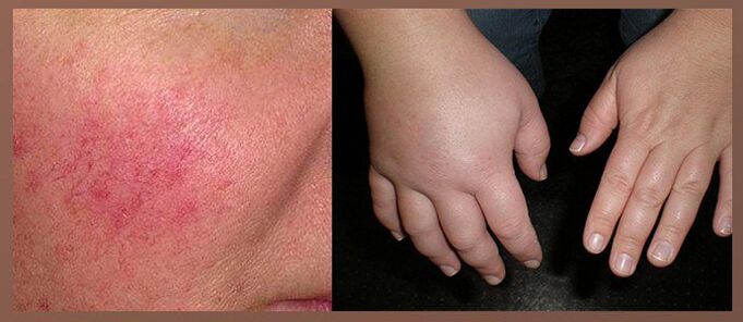 Παρενέργειες των σταγόνων