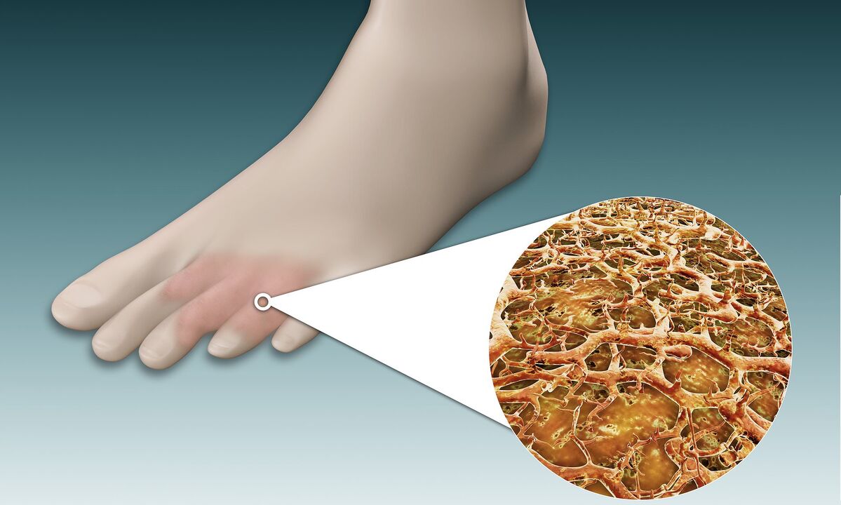 σπόρια μυκήτων στα πόδια